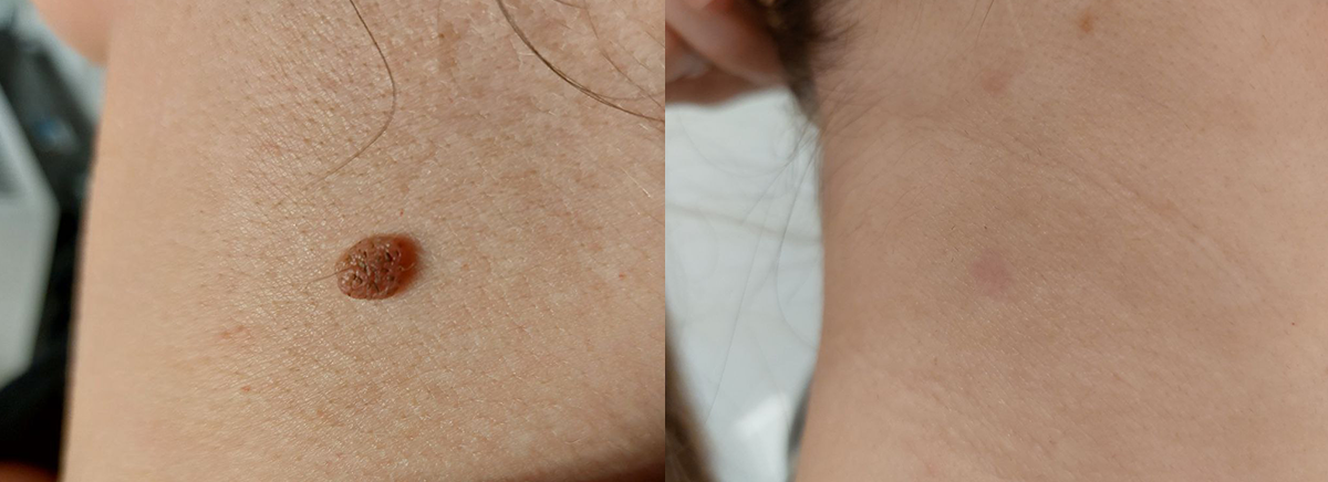 удаление невуса