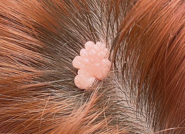 Удаление новообразований фото до и после