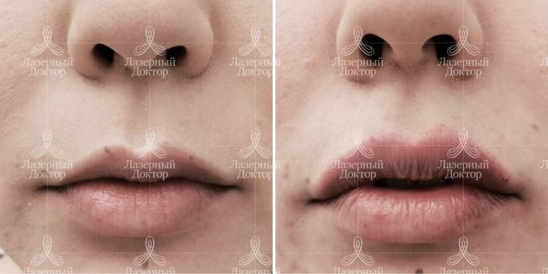 Контурная пластика губ