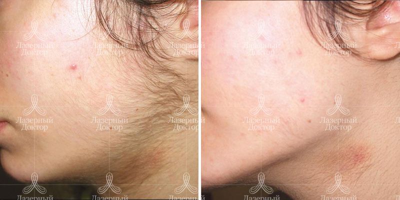 Moveo эпиляция Motus (фото до и после)