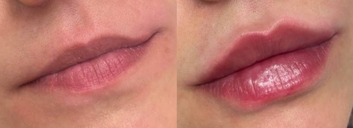 Контурная пластика губ 
