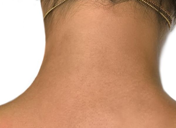 Лазерная эпиляция фото до и после