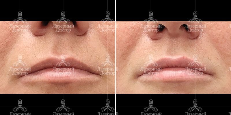 контурная пластика губ