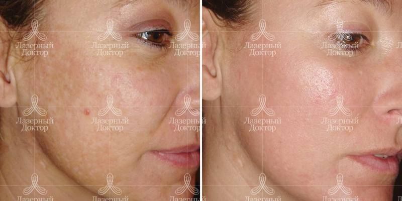 Фракционное омоложение fraxel
