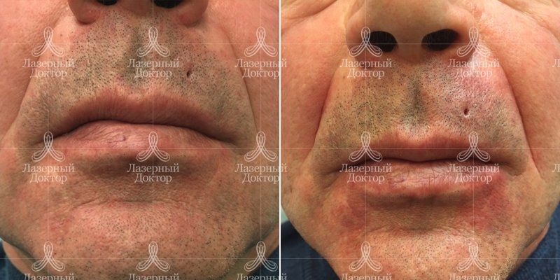 Удаление шрамов