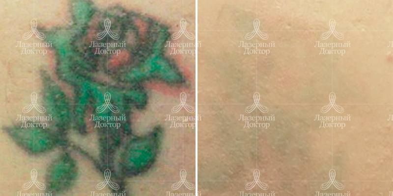 Удалить тату лазером: фото