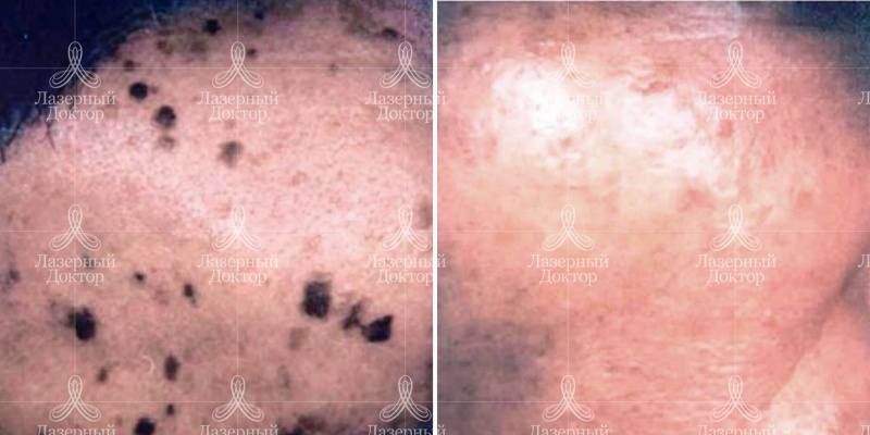 Лазерное удаление пигментации
