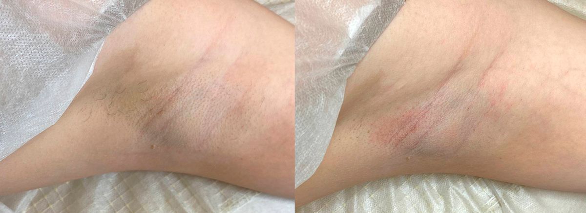 Эпиляция трайпл