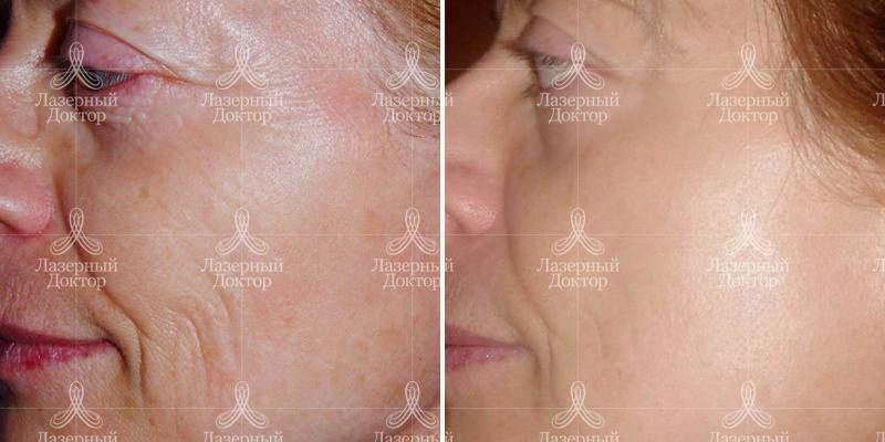 Лазерная шлифовка Фраксель