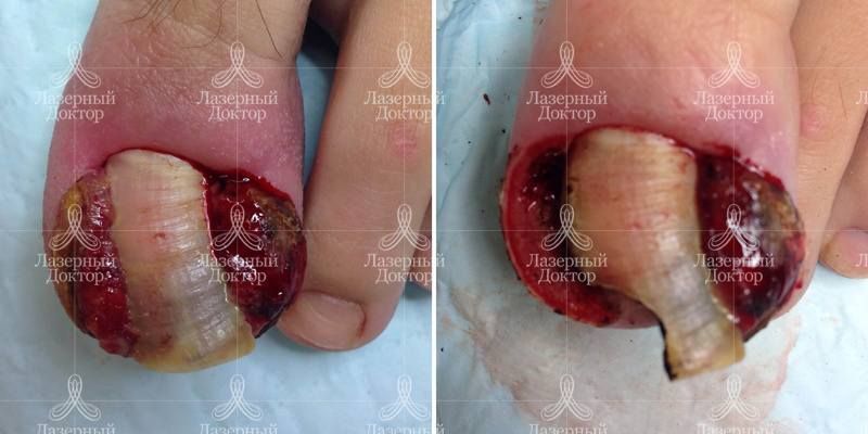 Удаление вросшего ногтя лазером