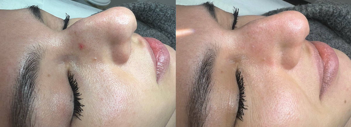 удаление ангиомы