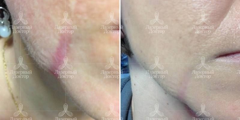 Пилинг: фото до и после