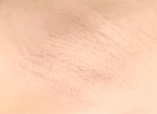 Лазерная эпиляция фото до и после