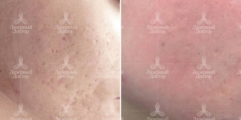 ДОТ лазерное омоложение