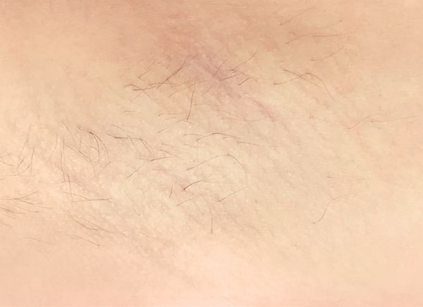 Лазерная эпиляция фото до и после