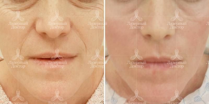 3д волюмизация