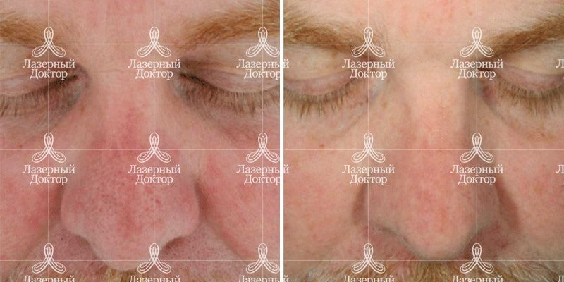Hydrafacial (фото до и после)
