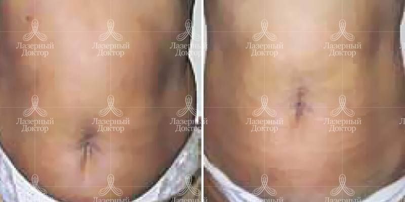 Интралипотерапия (фото)