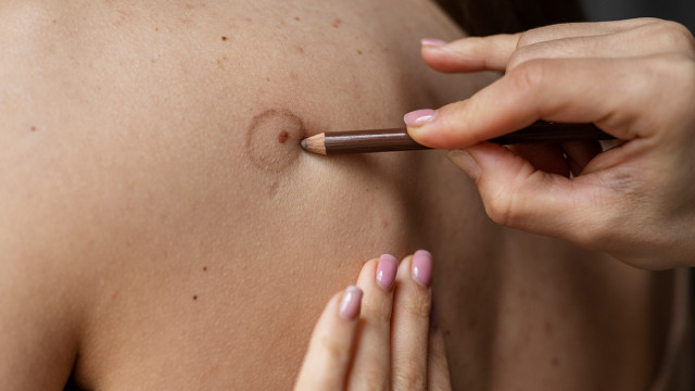 Как удалить родинку. Самый безопасный метод