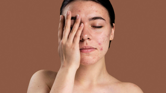 Что такое акне и как его лечить?