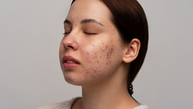 Лечение акне. Чистая кожа, не мечта - реальность