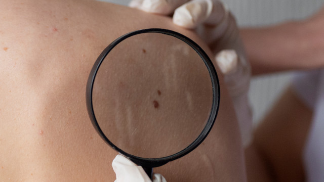 К какому врачу обратиться при новообразованиях на коже?