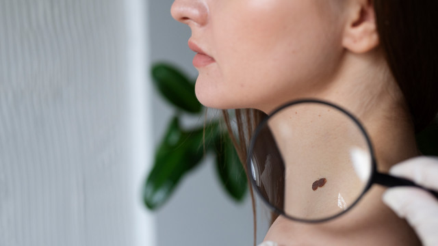 Кондиломы у женщин: причины, симптомы, лечение, методы удаления