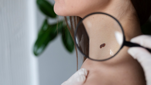 К какому врачу обращаться с родинками?