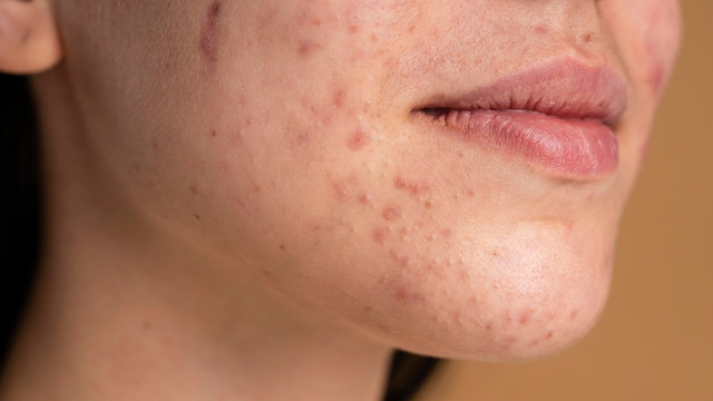 Что такое акне и как его лечить?