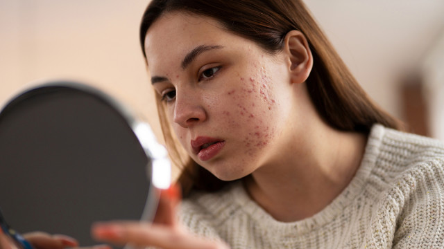 Лечение угревой сыпи у женщин