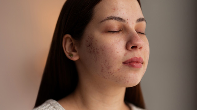 Лечение угревой сыпи у женщин