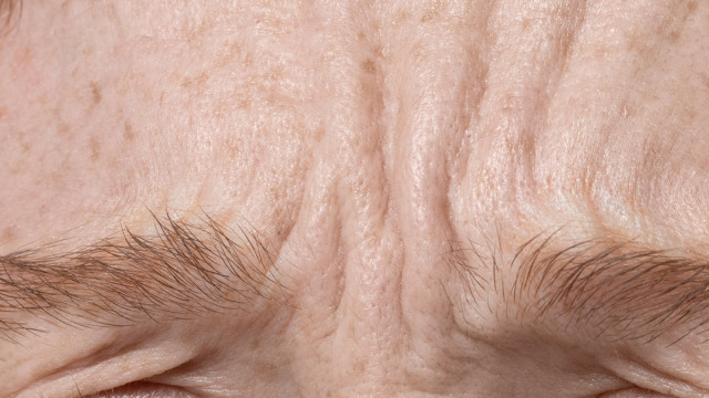 Ботулотоксин и его влияние на мимические морщины