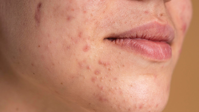 Эффективное лечение угревой сыпи (акне). Как избавиться от прыщей