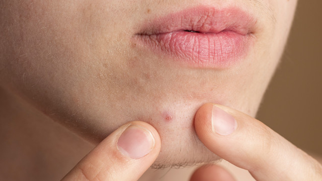 Акне. Лечим и забываем. Лечение акне на лице.