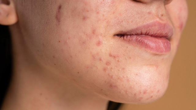 Советы косметолога: Как избавиться от прыщей?