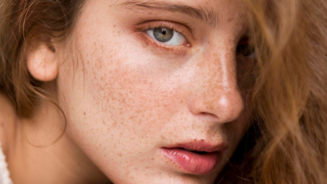 Мелазма: что это такое и как от нее избавиться?