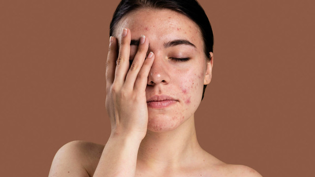 Советы косметолога: Как избавиться от прыщей?