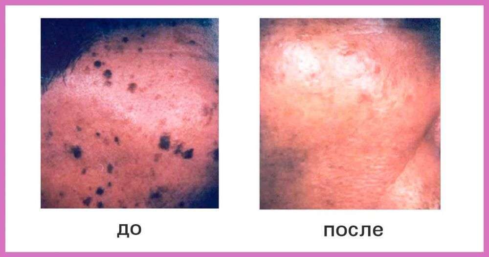 Процедуры для идеальной кожи