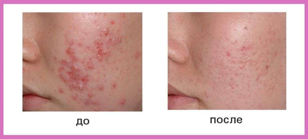 Процедуры для идеальной кожи