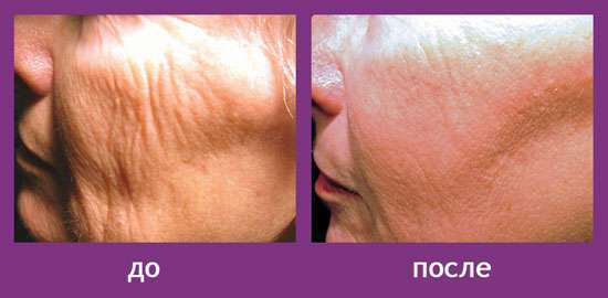 Процедуры для идеальной кожи