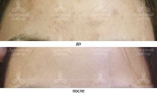 Акне. Лечим и забываем. Лечение акне на лице.