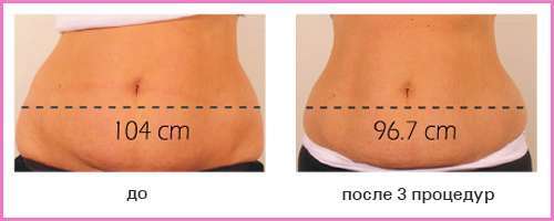 Эффект RF-лифтинга: тело