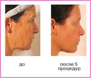 Эффект RF-лифтинга: лицо