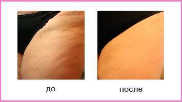 Эффект RF-лифтинга: тело