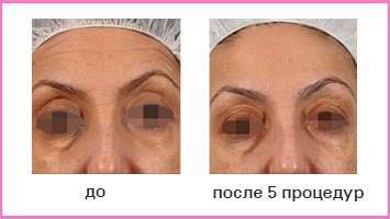 Эффект RF-лифтинга: лицо