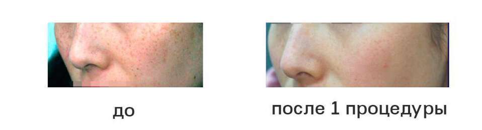 Удаление веснушек лазером фото до и после