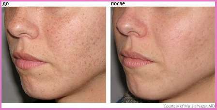 удаление веснушек