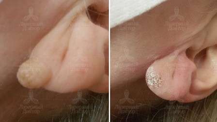 атерома за ухом