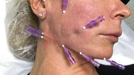 как подтянуть овал лица