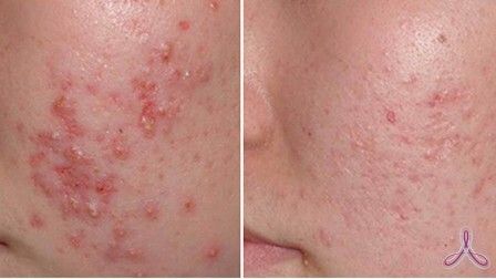 методы лечения акне